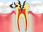 C3【神経まで達した虫歯】