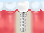 インプラント