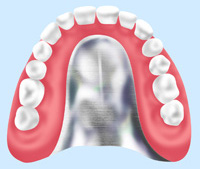 自費診療の入れ歯